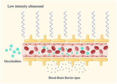 Effects of low-intensity ultrasound opening the blood-brain barrier on Alzheimer's disease—a mini review